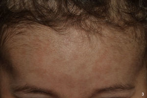 Máculas hiperpigmentadas en región frontotemporal en niña de origen sudamericano de un año.