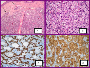 a)Imagen histológica de lesión de cuero cabelludo. Nódulos epiteliales rodeados de fibrosis e invasión linfática de células tumorales (H-E, ×40). b)Estructuras foliculares tapizadas por células redondas de citoplasma claro y núcleos pleomórficos (H-E, ×100). c)TTF-1 positiva (tinción IHQ). d)Galectina-3 positiva (tinción IHQ).