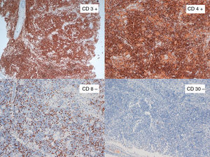 En el estudio inmunohistoquímico destaca la positividad para CD3 y CD4 en las imágenes superiores y la negatividad para CD8 y CD30 en las imágenes inferiores. El escaso marcaje de CD 8 corresponde a celularidad acompañante y no a la celularidad tumoral.
