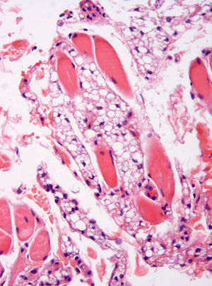 Immature adipocytes can be seen infiltrating between the fascicles of the orbicularis muscle (hematoxylin and eosin, original magnification ×100).
