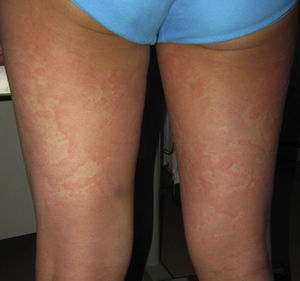 Urticaria, reacción tipo i mediada por IgE.