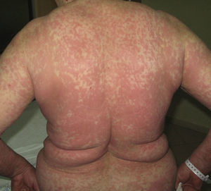 Exantema maculopapuloso, reacción de hipersensibilidad tipo iv, forma más frecuente de toxicodermia.