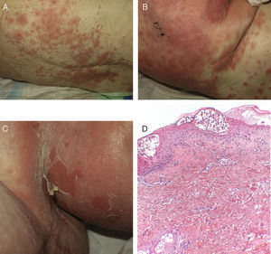 A y B. Placas eritematosas dianiformes en la espalda, evolución en 12h. C. Despegamiento en áreas con signo de Nikolsky positivo. D. Pústulas subcórneas e infiltrado dérmico subyacente perivascular leve con ocasionales eosinófilos y neutrófilos (H-E×100).