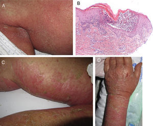 A. Exantema pustuloso inicial de predominio en pliegues. B. Pústula subcórnea espongiótica y denso infiltrado inflamatorio perivascular superficial con neutrófilos en la dermis. C y D. Erosiones, ampollas y despegamiento que mostró durante la evolución (H-E×100).