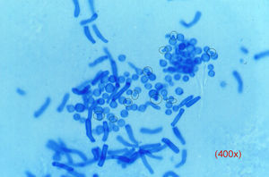 Examen directo de una pitiriasis versicolor (40×). Se aprecian blastosporos provistos de un nítido collarete de gemación y pseudomicelio corto y grueso, que han tomado el color azul de la tinta.