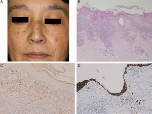 (A) Multiple keratotic plaques scattered on the face. (B) Biopsy showed parakeratosis with focal hyperkeratosis, follicular plugging, liquefaction changes to the basal layers of the epidermis, and cellular infiltrates in the upper dermis (hematoxylin–eosin stain, original magnification 100×). (C) Dylon staining revealed amyloid deposition in the upper dermis (original magnification 200×). (D) The upper dermis was also positive for keratin (original magnification 200×).