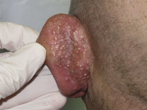 Múltiples pápulas blanquecinas milimétricas sobre base eritematosa en cara posterior del pabellón auricular.