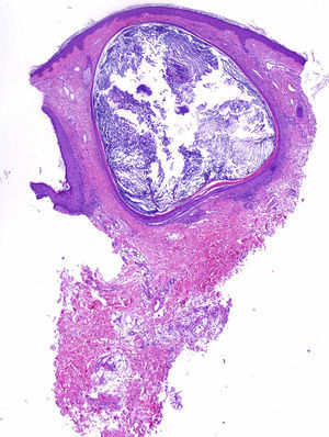 Cavidad quística que contiene queratina ortoqueratósica, recubierta de epitelio escamoso estratificado, en dermis superficial. Hematoxilina-eosina 10x.