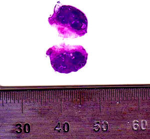 Carcinoma de células basales con patrón cilindromatoso. Imagen macro-microscópica en la que se observa la infiltración dérmica por una neoplasia basaloide.