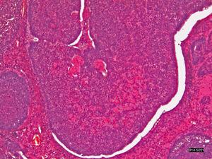 Carcinoma de células basales con patrón cilindromatoso. Detalle de un nido neoplásico constituido por células basaloides que conforman empalizadas periféricas rodeadas de artefacto de retracción. En el seno tumoral se observa gran cantidad de material amorfo, hialino tipo membrana basal (H&E ×100).