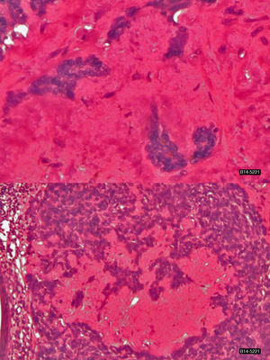 Carcinoma de células basales con patrón cilindromatoso. En ambas imágenes se aprecian distintas áreas tumorales en las que destaca la presencia de material amorfo, hialino rodeando células basales con discreta-moderada atipia (H&E ×200 y ×400).