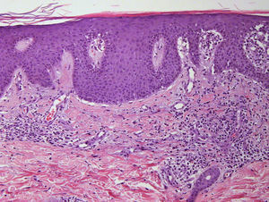 Acantosis psoriasiforme con paraqueratosis y ligero infiltrado inflamatorio superficial linfohistiocitario con extravasación de algunos hematíes. Cambios vacuolares focales de queratinocitos basales (H&E ×100).