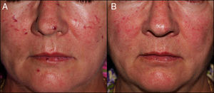 A) Paciente del caso 2: Telangiectasias mucocutáneas en nariz, ambas mejillas y labios. B) Gran aclaramiento de las lesiones tras 4 sesiones de tratamiento.