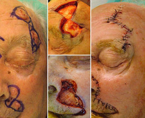 Paciente con múltiples tumores en la cara. Colgajo triangular de Burow para el cierre de los defectos en la sien izquierda. A nivel del pliegue alar izquierdo presenta 3 lesiones extirpadas mediante un colgajo de avance perialar semilunar.