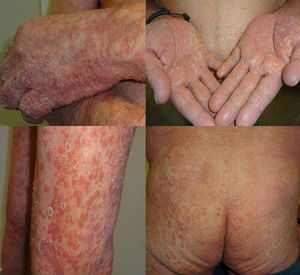 Detalle de la generalización de las lesiones de psoriasis tras el segundo ciclo de pembrolizumab.