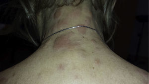 Placas eritematoedematosas no ulceradas de consistencia dura al tacto en región cervical posterior.