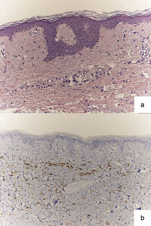 Estudio histológico: a) infiltrado dérmico de células en hilera por adenocarcinoma lobulillar de mama (H&E ×20); b) Grupos de células positivas que indican procedencia de tejido mamario, inmunohistoquímica: GCDFP-15 (×20).