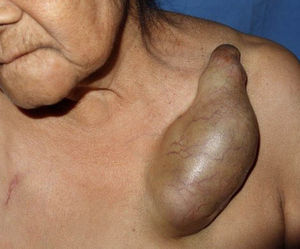 Tumoración firme, de superficie lisa y brillante, con telangiectasias, de bordes bien definidos, no adherido a planos profundos, no doloroso a la palpación.