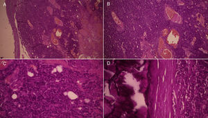 A) (H&E ×4) y B) (H&E ×10): nódulos de células epiteliales, que el algunas áreas, muestran una población de células ubicadas en la periferia, de aspecto basaloide. C) (H&E ×40) y D) (H&E ×40): células con citoplasma claro y escaso, que delimitan luces glandulares tubulares; en otras zonas, las células muestran menos diferenciación, con predominio claro de células basaloides, hipercromáticas y con escaso citoplasma, sin formación de estructuras ductales y con mitosis; se muestra calcificación. El estroma exhibe edema y canales vasculares dilatados y congestivos.