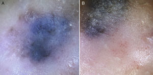 Dermatoscopia. A) Velo azul-blanquecino y áreas desestructuradas de color marrón y negro distribuidas irregularmente. B) Vasos glomerulares y puntiformes junto a descamación blanquecina fina a nivel del halo eritemato-descamativo.