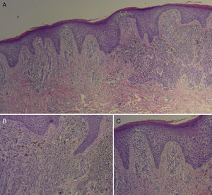 Histopatología: A) Proliferación de melanocitos atípicos con fase de crecimiento radial y vertical, migración intraepidérmica de melanocitos, y nidos y placas irregulares que infiltran la dermis papilar (H&E ×4). B) Células atípicas con núcleos grandes e irregulares, nucléolos evidentes y ocasionales vacuolas intranucleares (H&E ×10). C) Epidermis adyacente con acantosis, espongiosis moderada y exocitosis de linfocitos, junto a un infiltrado inflamatorio mononuclear dispuesto en forma perivascular en la dermis (H&E ×10).