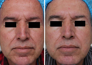 Before and after clinical photographs. After treatment with MAL+daylight, facial skin appears lighter, with improvement of frontal wrinkles and of nasolabial folds and perioral wrinkles.