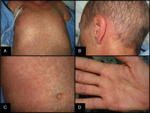 Clínica de la EICH aguda. A. Exantema macular foliculotropo confluente de predominio troncular. B. Afectación retroauricular. C. Detalle del exantema. D. Afectación palmar.