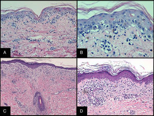 Histopatología de la EICH cutánea. A y B. Aguda. HE×20 y HE×40. Dermatitis de interfase vacuolar con apoptosis de queratinocitos y presencia de linfocitos satélite. C y D. Crónica. HE×10 y HE×20. Dermatitis de interfase con despegamiento dermo-epidérmico con afectación del folículo.