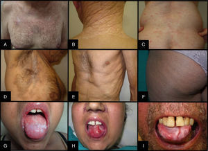 Clínica de la EICH crónica cutánea y mucosa. A. Poiquilodermia; B. LEA extragenital; C. Liquenoide; D. Morfea; E. Fascitis; F. Queratosis pilar; G. Liquen plano oral; H. Erosiones y úlceras orales; I. Hiperqueratosis y fisuras orales.
