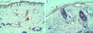 In patients with a darker phototype, severe epidermal damage with full epidermal necrosis (§) was noted with (1a) high fluences (19.4J/cm2) in patient 2 and (1b) lower fluences: 13J/cm2 in patient 7. In these patients, focal intravascular coagulation was also seen (¥). No dermal damage was observed.