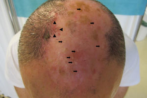 En área parietal y vértex, placa de alopecia cicatricial con numerosas lesiones papulosas blancas en su interior (), y pápulas y pústulas foliculares, y foliculitis en penacho en sus márgenes (▴).