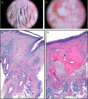 A) Imagen dermatoscópica. Politriquia, pústulas foliculares y áreas rojo-lechosas con pérdida de orificios foliculares. B) En dermis, infiltrado inflamatorio crónico granulomatoso histiocitario perifolicular (hematoxilina-eosina ×100). C) Imagen dermatoscópica. Áreas blanquecinas. D) Tejido óseo maduro con médula ósea inmerso en colágeno dérmico y tejido celular subcutáneo (hematoxilina-eosina ×100).
