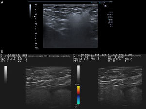A. Imagen hiperecogénica localizada en tejido celular subcutáneo, de morfología arriñonada, ecoestructura homogénea de límite superior y laterales nítidos y pérdida de borde profundo por artefacto en tormenta de nieve. B. Dos imágenes hiperecogénicas adyacentes pseudoencapsuladas en «tormenta de nieve» en tejido subcutáneo. Ausencia de vascularización con doppler color.