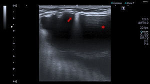 Prótesis mamaria unicameral y subglandular. Flecha: artefacto producido por el gel extravasado al espacio comprendido entre el pliegue de la cubierta externa de la prótesis y la cápsula externa fibrótica, hallazgo relacionado con rotura intracapsular. Estrella: artefacto de reverberación.