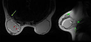 Flechas rojas: salad oil sign (gotas de suero flotando dentro del gel de silicona) indicativo de rotura intracapsular. Flechas verdes: siliconomas periprótesis y axilar.