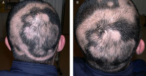 A) En vértex y región occipital, zonas anulares con crecimiento de pelo negro. B) Extensión de placa alopécica inicial hacia área parietal.