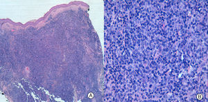 A) La imagen panorámica muestra un infiltrado denso en dermis, que se extiende a tejido celular subcutáneo, sin epidermotropismo (hematoxilina-eosina ×4). B) El infiltrado está constituido principalmente por linfocitos pleomórficos de pequeño y mediano tamaño (hematoxilina-eosina ×40).
