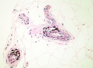 Biopsia que muestra calcificación de la capa media de los vasos del tejido celular subcutáneo (hematoxilina y eosina, ×200).