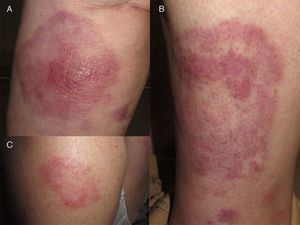 A) Placa eritematosa redondeada, con centro nodular más infiltrado, en la pierna. B) Placa eritematosa anular en la otra pierna. C) Placa única en el brazo.