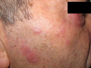 Placas eritematosas en mejilla y párpado inferior.