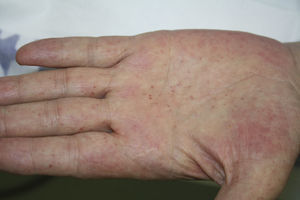 Lesiones vesiculosas sobre base eritematosa en la palma de la mano del segundo paciente.