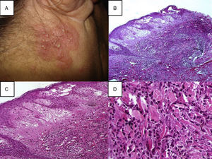 (A) A papulopustular lesion localizated on the head, in the posterior region of the right ear, a skin biopsy (Punch 4) was performed and stained with hematoxylin–eosin; (B) Histopathology reveals diffuse neutrophilic infiltrate with significant papillary dermal edema, 10×; (C) Papillary dermal edema, perivascular and interstitial infiltrate composed predominately of neutrophils, scattered lymphocytes, histiocytes, and eosinophils, 20×; (D) The infiltration was predominantly composed of neutrophils and histiocytes, 40×.
