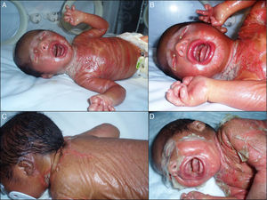 A. Membrana brillante que cubre a modo de coraza la práctica totalidad de la superficie corporal. B. Ectropión, eclabium y manos en garra. C. Retracción del pabellón auricular izquierdo y membrana en la espalda con fisura en la zona central dorsal. D. Descamación en grandes láminas que afecta a toda la membrana.