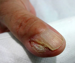 Queratoacantoma; fotografía clínica. Lesión nodular, color piel que compromete el borde ungueal y periungueal ulnar y proximal del dedo pulgar derecho.