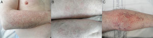 Placas telangiectásicas que afectaban simétricamente la cara externa de los antebrazos (A). Telangiectasias en los muslos (B) y en las piernas (C).