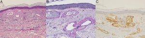 A. Vasos dilatados, de contorno irregular y paredes engrosadas en la dermis papilar (hematoxilina-eosina ×40). B. Depósitos de material homogéneo eosinofílico PAS positivo alrededor de las luces vasculares (PAS-diastasa, ×100). C. Dichos depósitos presentaban inmunotinción positiva para el colágeno iv.