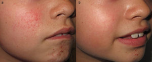 Paciente con angiofibromas faciales asociados a esclerosis tuberosa antes (a) y 6 meses después de iniciar tratamiento con sirolimus tópico (b).