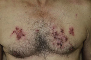 Múltiples trayectos serpiginosos en el tronco.