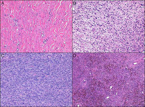 Variedades histológicas de dermatofibrosarcoma protuberans (DFSP). A) Esclerosante; B) Mixoide; C) Fibrosarcomatosa; D) Pigmentada.