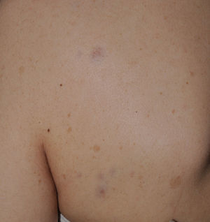 Neurofibromas cutáneos. Máculas rojo-azuladas en el lateral izquierdo de la espalda en una paciente adolescente.